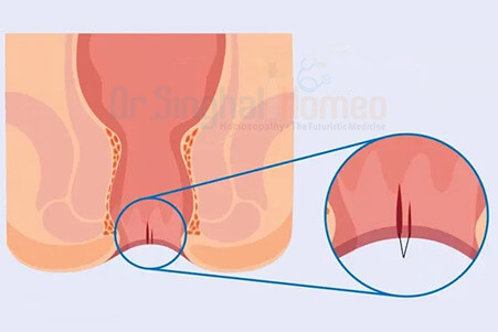 Homeopathic Medicine for Anal Fissure | Fissure Treatment in Homeopathy