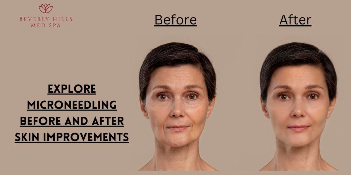 Explore Microneedling Before and After Skin Improvements