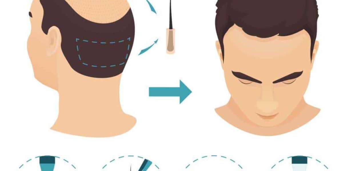 FUE vs. DHI: Which Is the Best Hair Transplant in South Delhi?